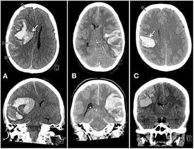 Vaccine Induced Immune Thrombotic Thrombocytopenia Causing a Severe Form of Cerebral Venous Thrombosis With High Fatality Rate: A Case Series